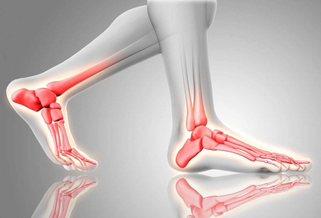 semelle orthopédique orthopiana réduit les douleurs